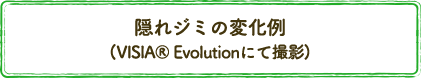隠れジミの変化例　(VISIA&reg; Evolutionにて撮影)